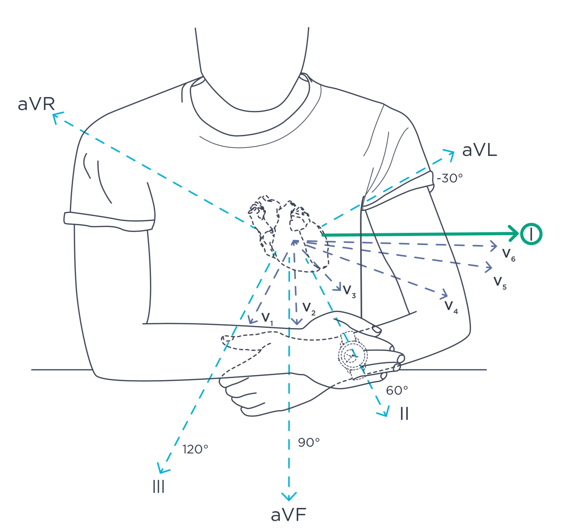 Diagram showing 12-lead ECG configuration versus single Lead I used by Withings devices