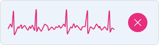 Example of an atrial fibrillation ECG tracing