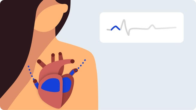 ECG signal highlighting the P wave